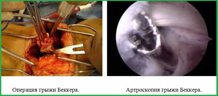 Операция грыжи Беккера. Артроскопия грыжи Беккера.