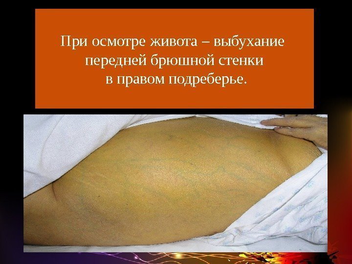 Фото части живота с грыжей.