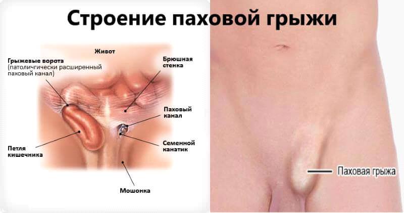 Строение паховой грыжи