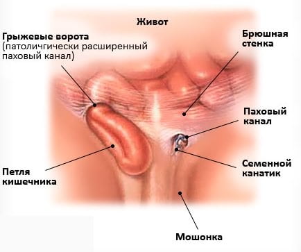 Строение паховой грыжи