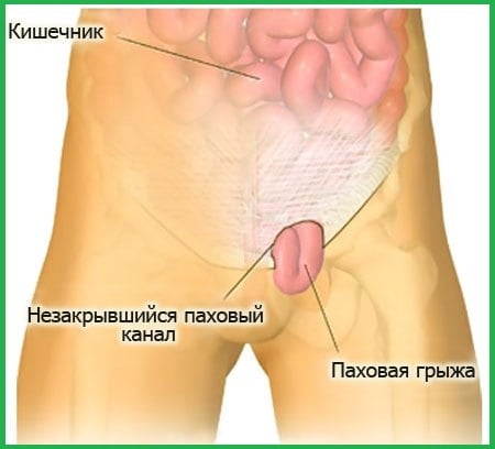 Рисунок с паховой грыжей