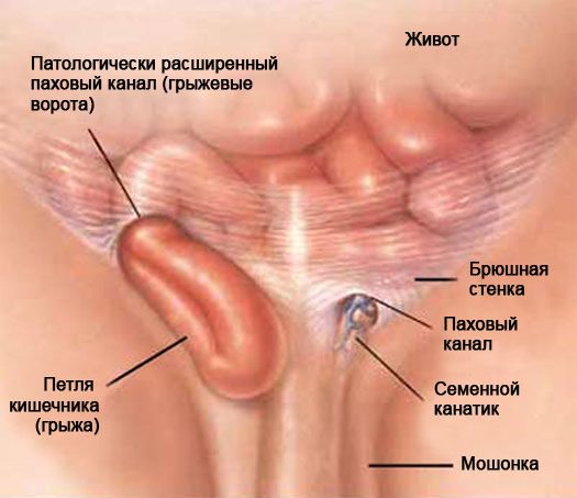 Анатомический рисунок паховой патологией