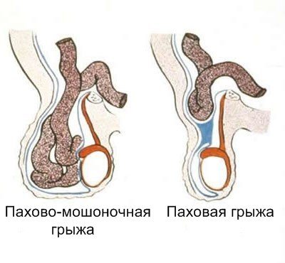 рисунок с паховой грыжей