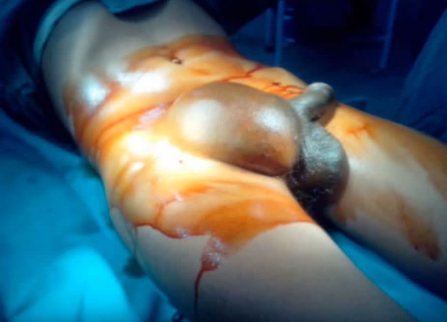 Фото пациента с грыжей яичка