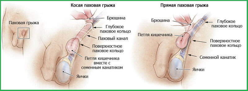 Схематичный рисунок паховой грыжи