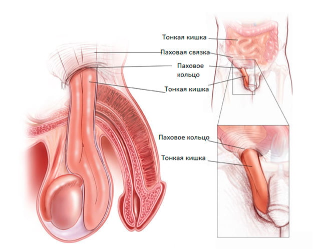 Опускание тонкой кишки