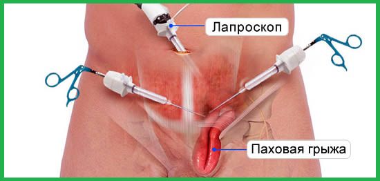 рисунок с паховой грыжей