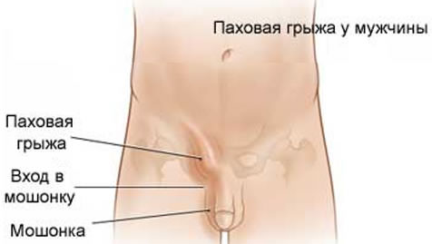 рисунок с паховой грыжей