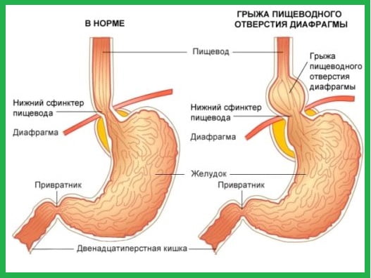 Схематический рисунок грыжи пищевода.