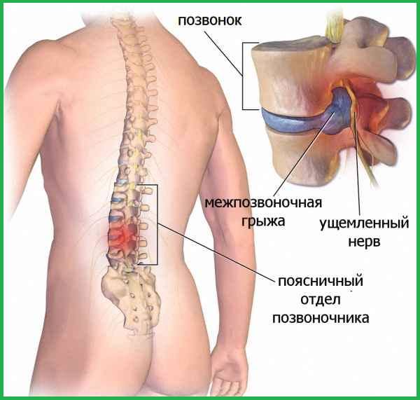 Рисунок человека с межпозвоночной грыжей.