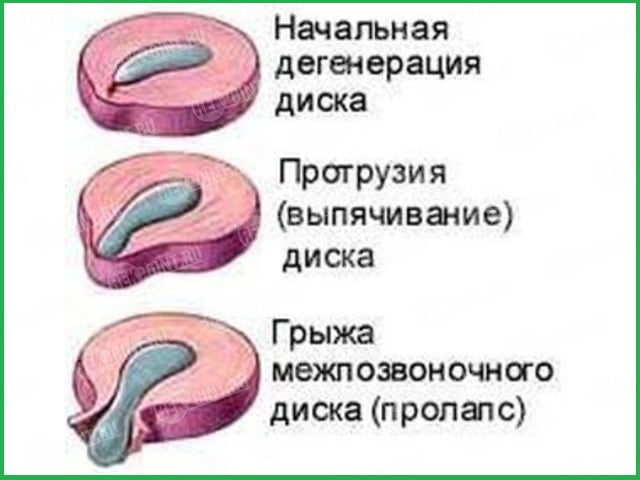 Схематичный рисунок трех стадий.