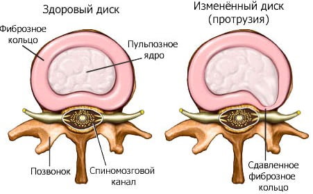 Схематичный рисунок появления паталогии