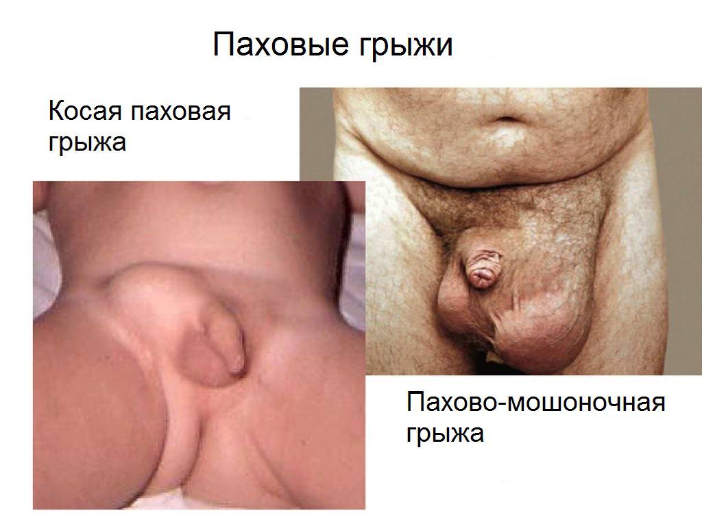 Фото паховых грыж.