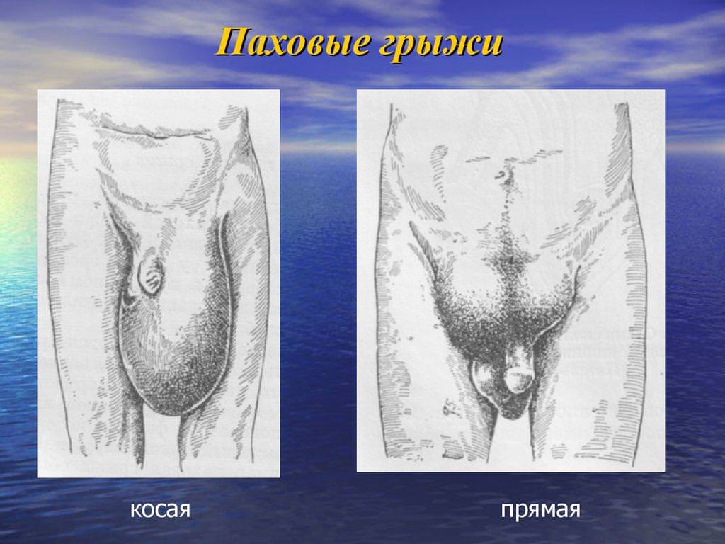 Рисунок косой и прямой патологии.