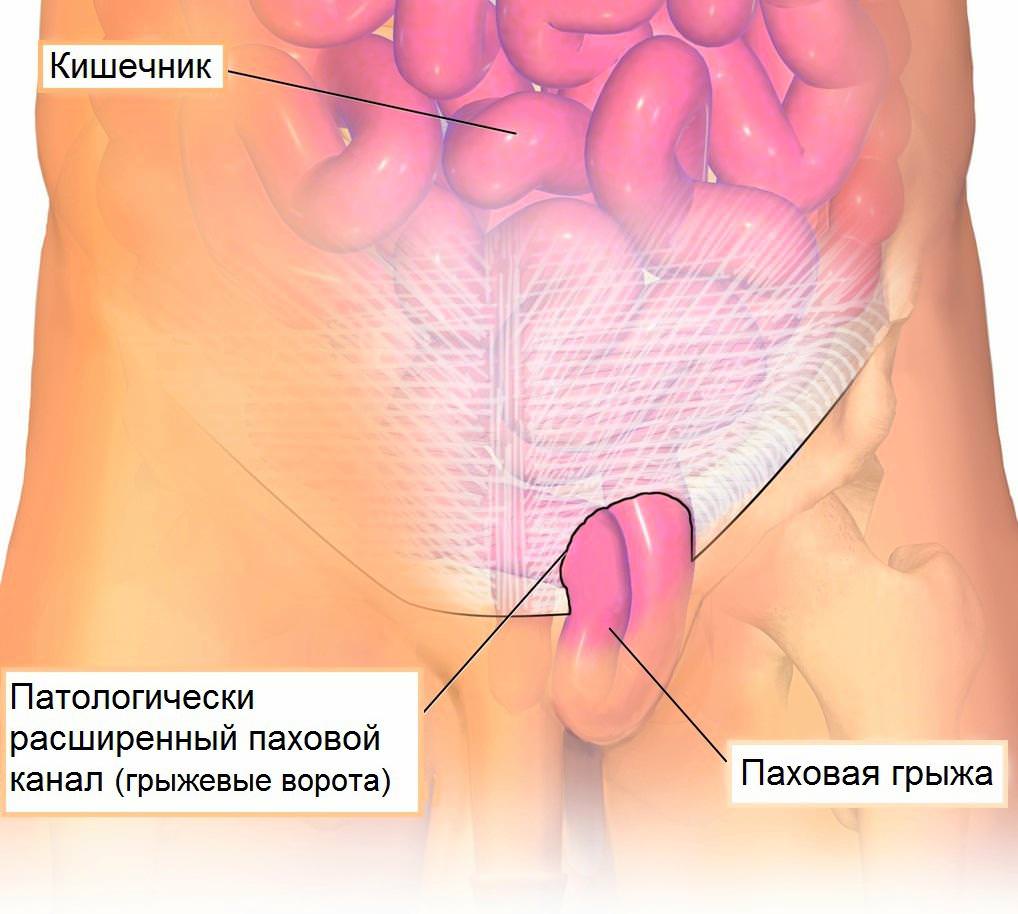 Рисунок патологии пахового канала.