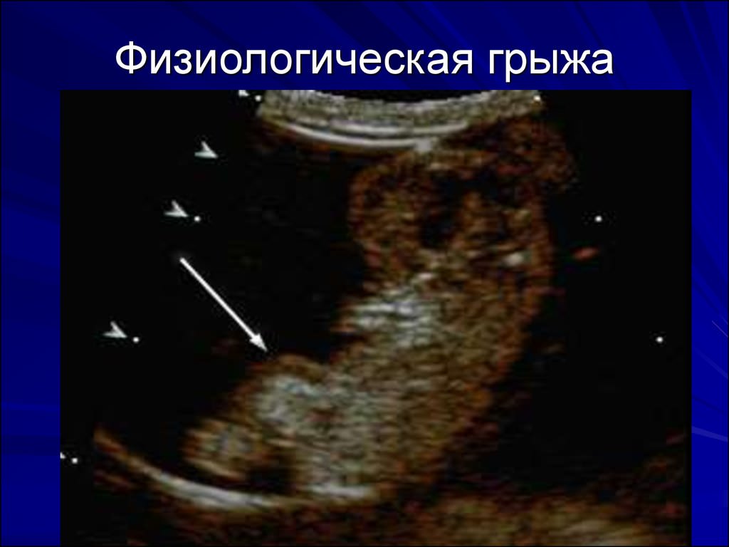 Физиологическая грыжа у плода.