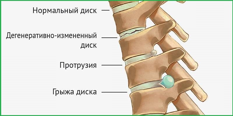 Рисунок позвоночника с грыжей.