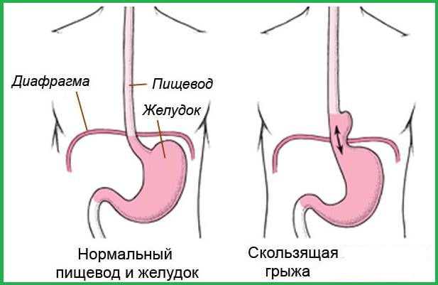 Рисунок сравнения здорового пищевода и с грыжей