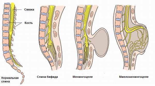 spina-bifida-rus