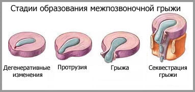 (Картинка «стадии грыжи»