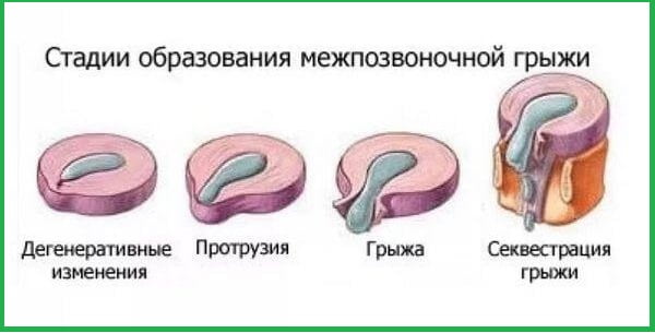 Рисунок изображает стадии грыж.