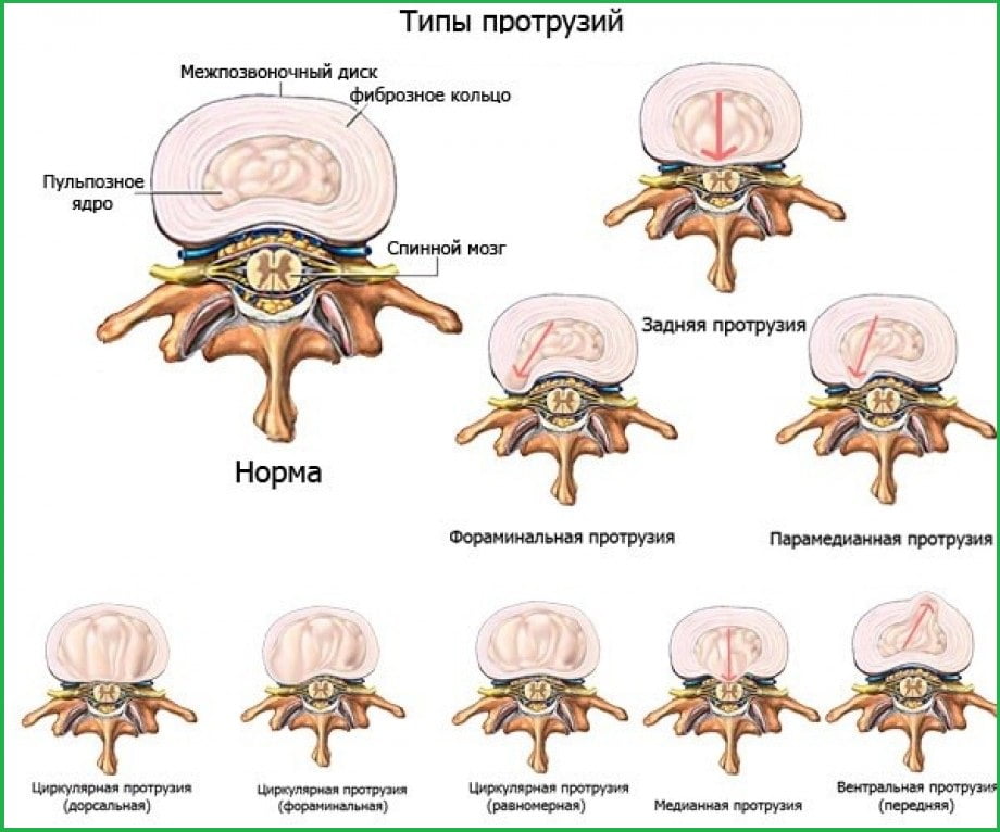 Типы протрузий. в виде рисунка