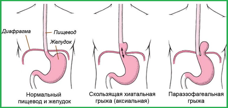 скользящая пищевая фиксированная грыжа