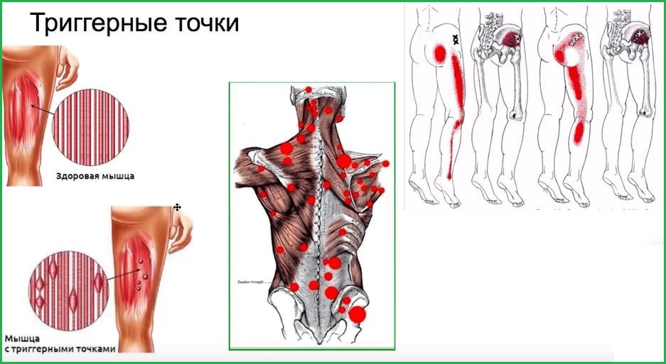 Мышца с тригирными точками.