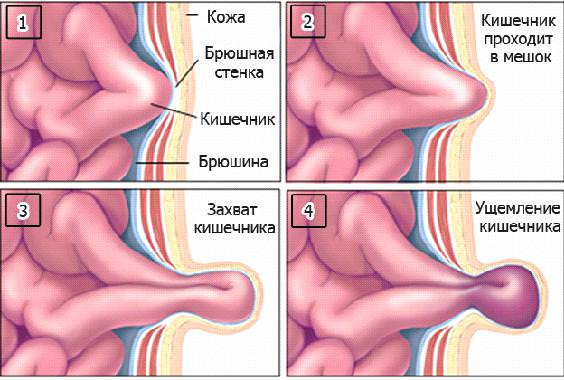 Схематический рисунок ущемления