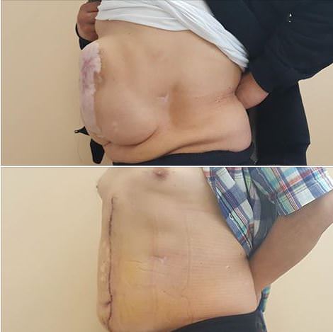 Фото пациента до и после операции