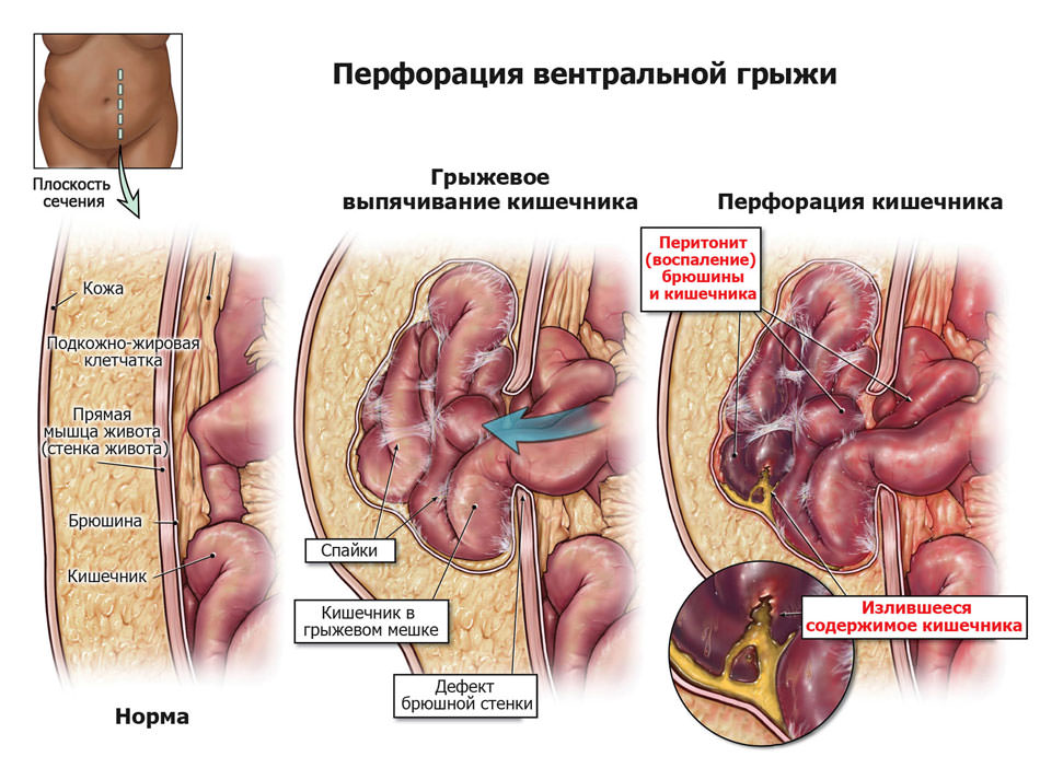 Перфорация вентральной грыжи.