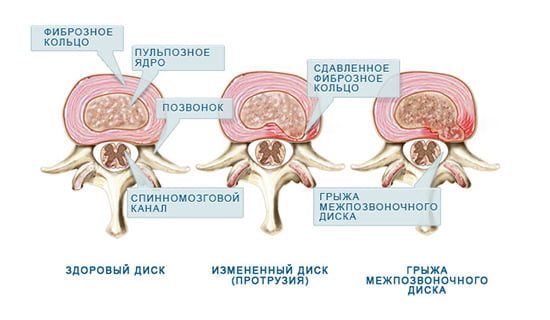виды грыж
