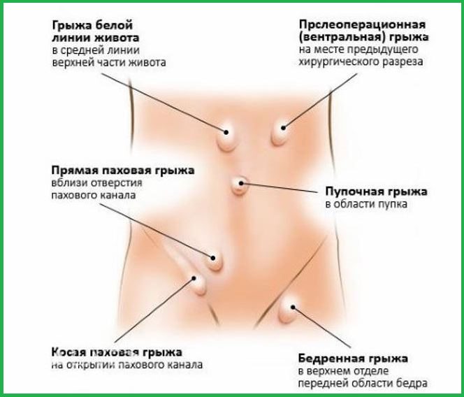 Схематический рисунок с видами грыж.
