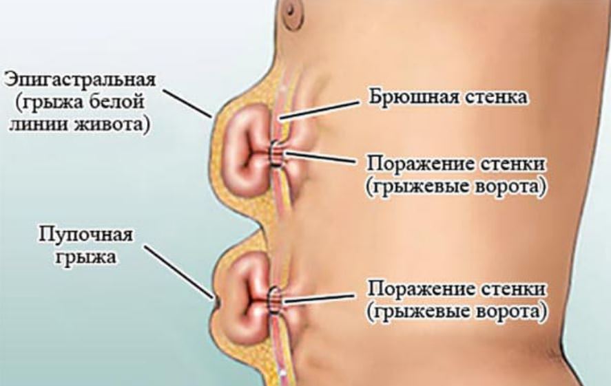 Рисунок показывающий грыжу на животе.