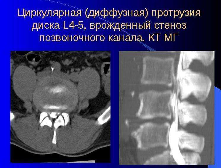 Рентген циркулярной диффузной протрузии.