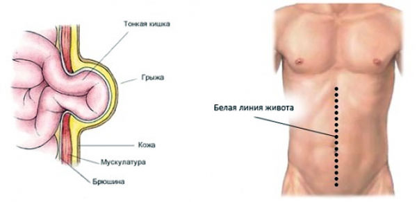 Схематичный рисунок грыжи белой линии живота