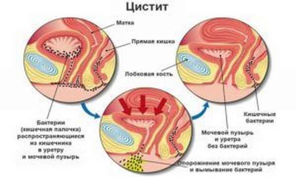 Цистит