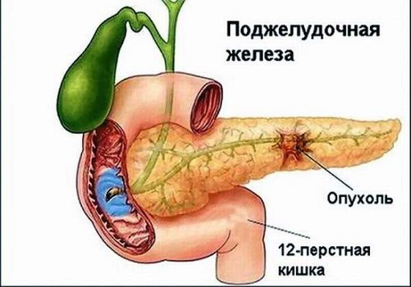 локализация рака ПЖ