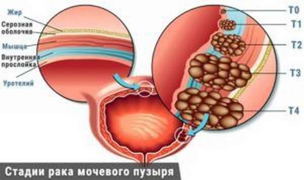 Рак мояевого пузыря