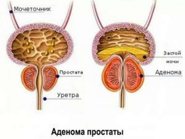 Аденома простаты