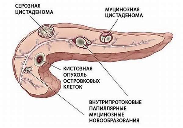 Кисты в поджелудочной железе
