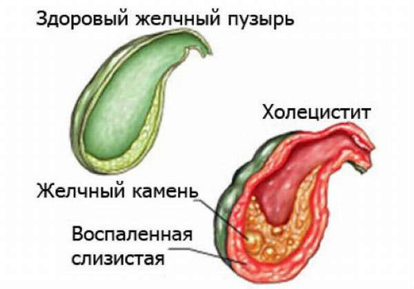 больной желчный пузырь