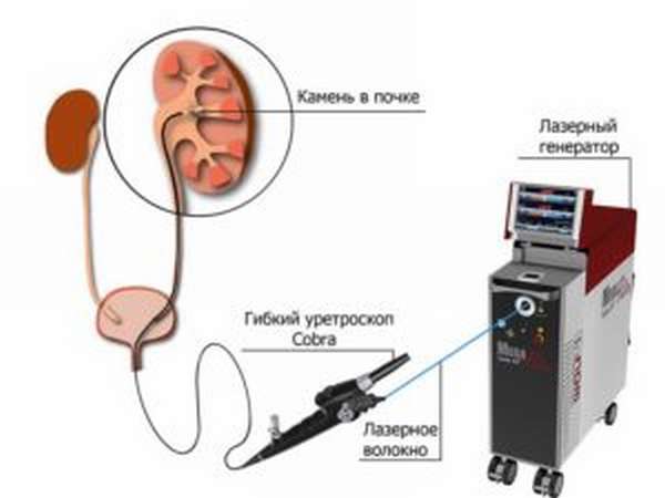 Удаление камней