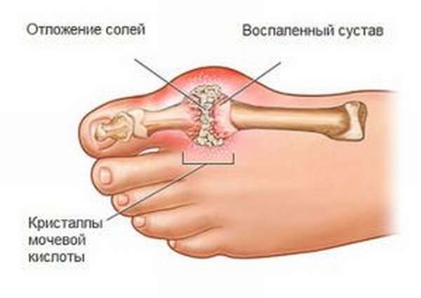 Отложения мочевой кислоты
