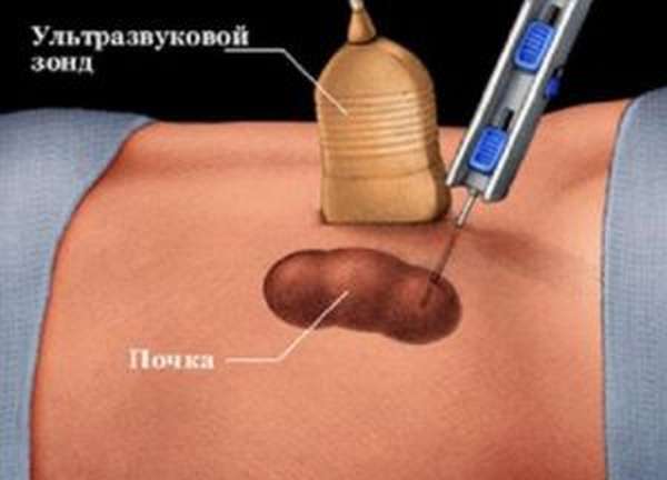 пункция кисты почек 