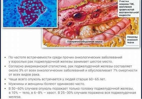 Новообразования в ПЖ
