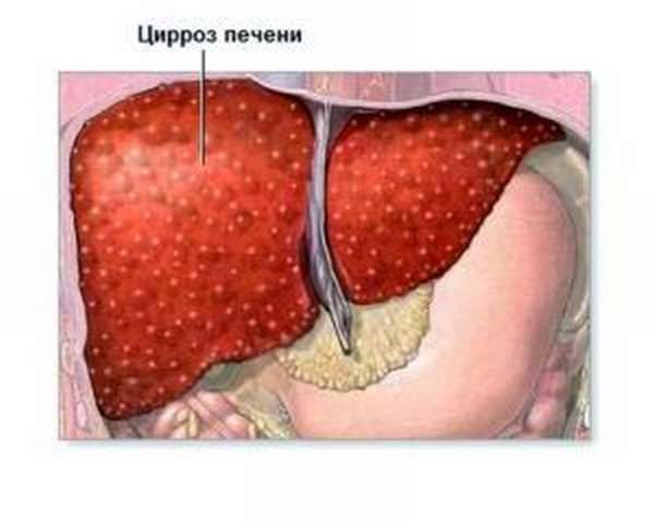 Цирроз печени