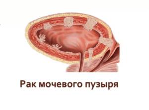  Рак мочевого пузыря