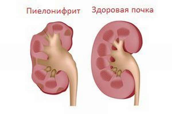 Пиелонефрит