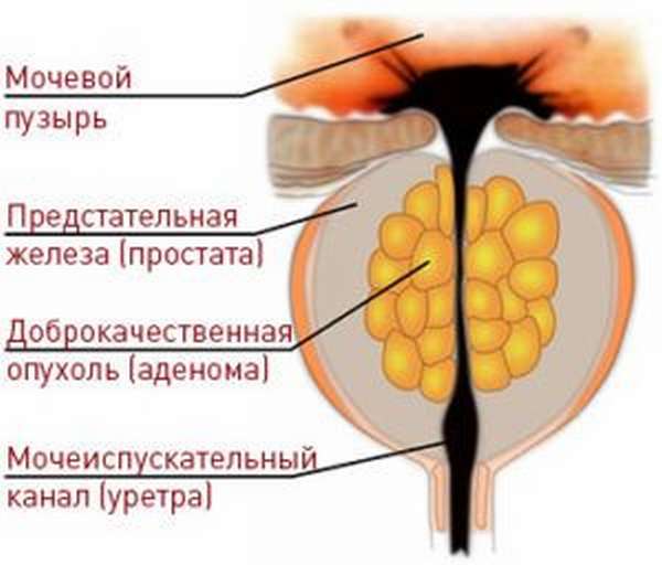 Аденома простаты